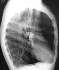 A lateral chest X-ray of a person with emphysema, displaying barrel chest and flat diaphragm