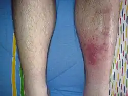 Infected left shin in comparison to the right-sided shin with no sign of symptoms.