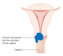 Stage 2A cervical cancer