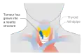 Stage T4a thyroid cancer