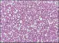 Micrograph of fatty liver showing lipid steatosis. H&E stain.