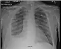 Fibrothorax and pleural effusion caused by silicosis