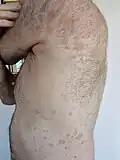 The rash of guttate psoriasis on a 66-year-old male