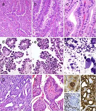 Columnar cell variant of papillary thyroid carcinoma (PTC) showing a combination of papillary and glandular-like patterns (a), marked nuclear pseudostratification, and less nuclear features of classic PTC (b). In the tall cell variant of PTC, the cytoplasm is deeply eosinophilic, and nuclear features of PTC are very prominent with irregular contours and common pseudoinclusions (c). Hobnail variant of PTC combining papillary (d), and micropapillary (e) structures lined by hobnail cells. “Teardrop” cells (f) and comet-like cells (inset). The cribriform-morular thyroid carcinoma exhibits a blending of cribriform, papillary, trabecular, and solid pattern with morules (g) and (h). Morules are strongly positive for CD10 (i). Tumor cells are reactive for estrogen receptors (j), and there is strong nuclear and cytoplasmic reactivity for β-catenin (k)[9]