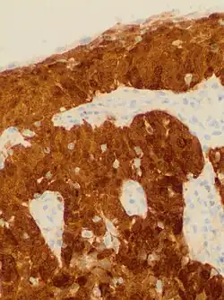 Cervical squamous cell carcinoma generally shows diffuse staining of both nuclei and cytoplasm on p16 immuno- histochemistry (except verrucous variant).[76]