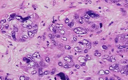 Invasive ductal carcinoma with marked nuclear pleomorphism.