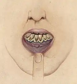 Mouth of a lead-mill worker.