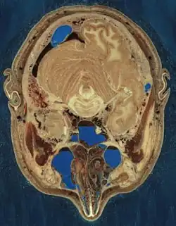 Cryosection of a human head