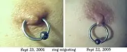 Side-by-side photos of the same male nipple and captive-bead ring, first at the ring's initial location, then, after four years of migration, at a location barely within the nipple.