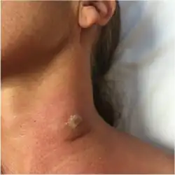 Ulcer of human African trypanosomiasis[14]