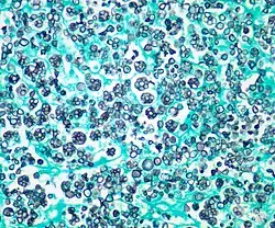 Photomicrograph (stained) of Prototheca wickerhamii infection in a human