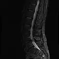 MRI lumbar spine with degeneration (sagittal FAST STIR)