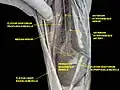 Anterior interosseous nerve.Deep dissection.Anterior.