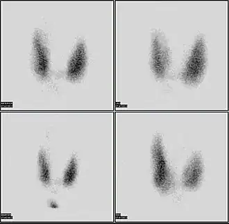 Thyroid scan with iodine-123 for evaluation of hyperthyroidism.