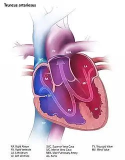 Illustration of truncus arteriosus in a fully formed heart
