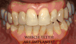 Mouth with many implant supported teeth where it is difficult to distinguish the real teeth from the prosthetic teeth.