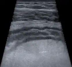 USG jamy brzusznej. Pogrubiała ściana esicy