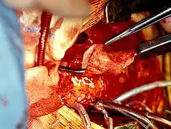 Proteza Contegra® przed wszczepieniem w zwężoną drogę odpływu z prawej komory serca