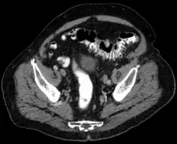 Obraz CT Niezmienione uchyłki esicy