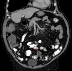 Obraz CT Stan zapalny uchyłków i ropień w jamie brzusznej