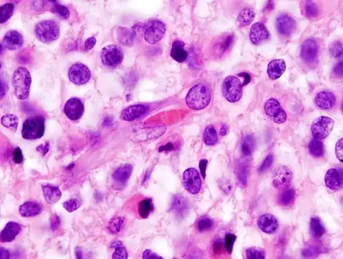 Widoczna nieregularność kształtów komórek i jąder.