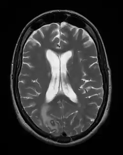 Przekrój poprzeczny rezonansu magnetycznego głowy