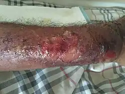 Ręka pokryta strupami oraz ropniami charakterystycznymi dla skórnej odmiany wąglika