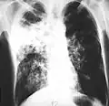 Bardzo zaawansowane zmiany. Zmiany gruźlicze przede wszystkim w polu górnym i środkowym oraz jama w szczycie prawego płuca, 2004