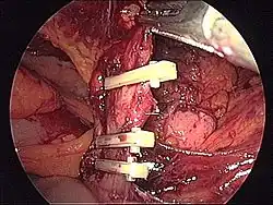 Zaopatrzenie naczyń przy pomocy wchłanialnych klipsów.