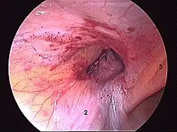 Ryc. 2 Śródoperacyjny widok kanału pachwinowego. 1. kanał pachwinowy 2. powrózek nasienny 3. naczynia nabrzuszne dolne.