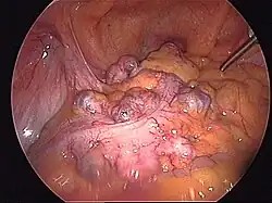 Śródoperacyjny widok uchyłków esicy (operacja laparoskopowa).