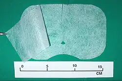 Ryc. 15. Proteza dwuczęściowa przygotowana z „lekkiego” materiału do operacji przepukliny pachwinowej.