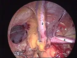 Ryc. 4 Śródoperacyjny widok przepukliny pachwinowej kombinowanej (tzw. pantaloon hernia). 1. komponenta przyśrodkowa 2. naczynia nabrzuszne dolne 3. kanał pachwinowy 4. powrózek nasienny