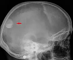 Zdjęcie boczne czaszki –&nbsp;widoczny oponiak