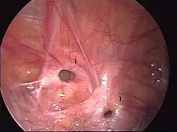 Ryc. 3 Śródoperacyjny obraz przepukliny pachwinowej nawrotowej. 1. mnogie ubytki w powięzi poprzecznej.