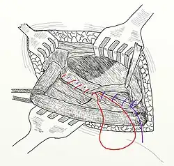 Ryc. 13 Operacja metodą Shouldice’a. Pierwsza i druga warstwa szwów zakładana na powięź poprzeczną.