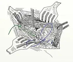 Ryc. 14 Operacja metodą Shouldice’a. Trzecia i czwarta warstwa szwów zakładana na mięsień skośny wewnętrzny i więzadło pachwinowe.