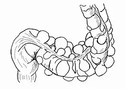Schematyczny rysunek uchyłków esicy.