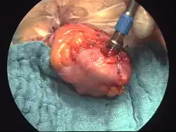 Zespolenie maszynowe (resekcja esicy). Założenie grzybka do proksymalnego odcinka jelita.