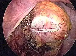 Zespolenie maszynowe (resekcja esicy). Założenie aparatu do kikuta odbytnicy – przygotowanie doperforacji szwu maszynowego, które powinno nastąpić centralnie w bezpośredniej bliskości szwu maszynowego.