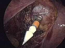 Zespolenie maszynowe (resekcja esicy). Sztyft wyprowadzony poza światło jelita. Po usunięciu perforatora (białe ostrze) zostanie połączony z grzybkiem znajdującym się w proksymalnej części planowanego zespolenia.