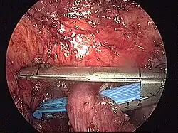 Kontynuacja resekcji staplerem liniowym. Resekcja przeprowadzona jest doogonowo od anatomicznej i czynnościowej esiczo-odbytniczej strefy wysokiego ciśnienia.