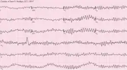  Zapis EKG migotania komór